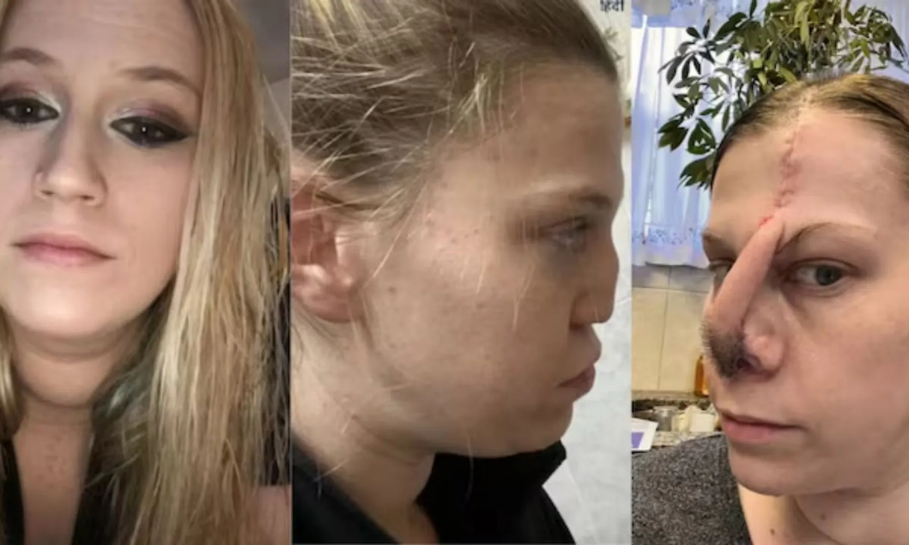  Cocaine addiction left a hole in woman's nose, took 15 surgeries to rebuild it post image
