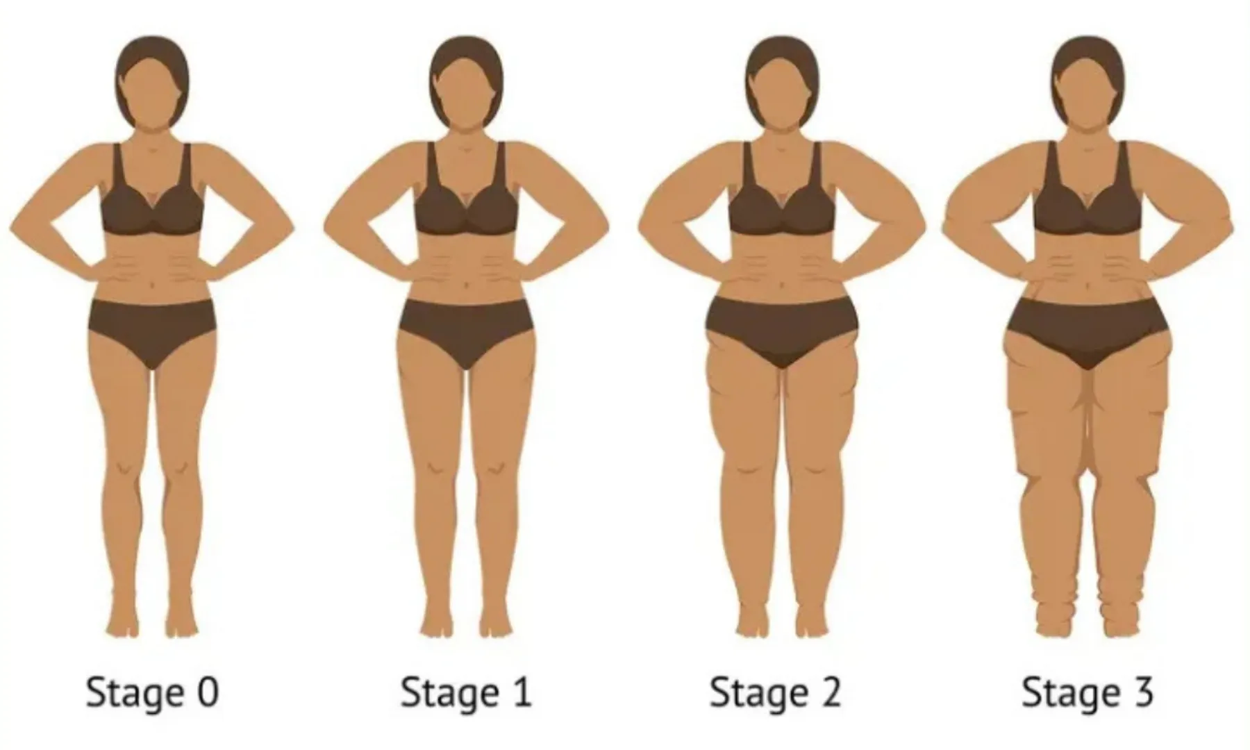 What is lipedema 