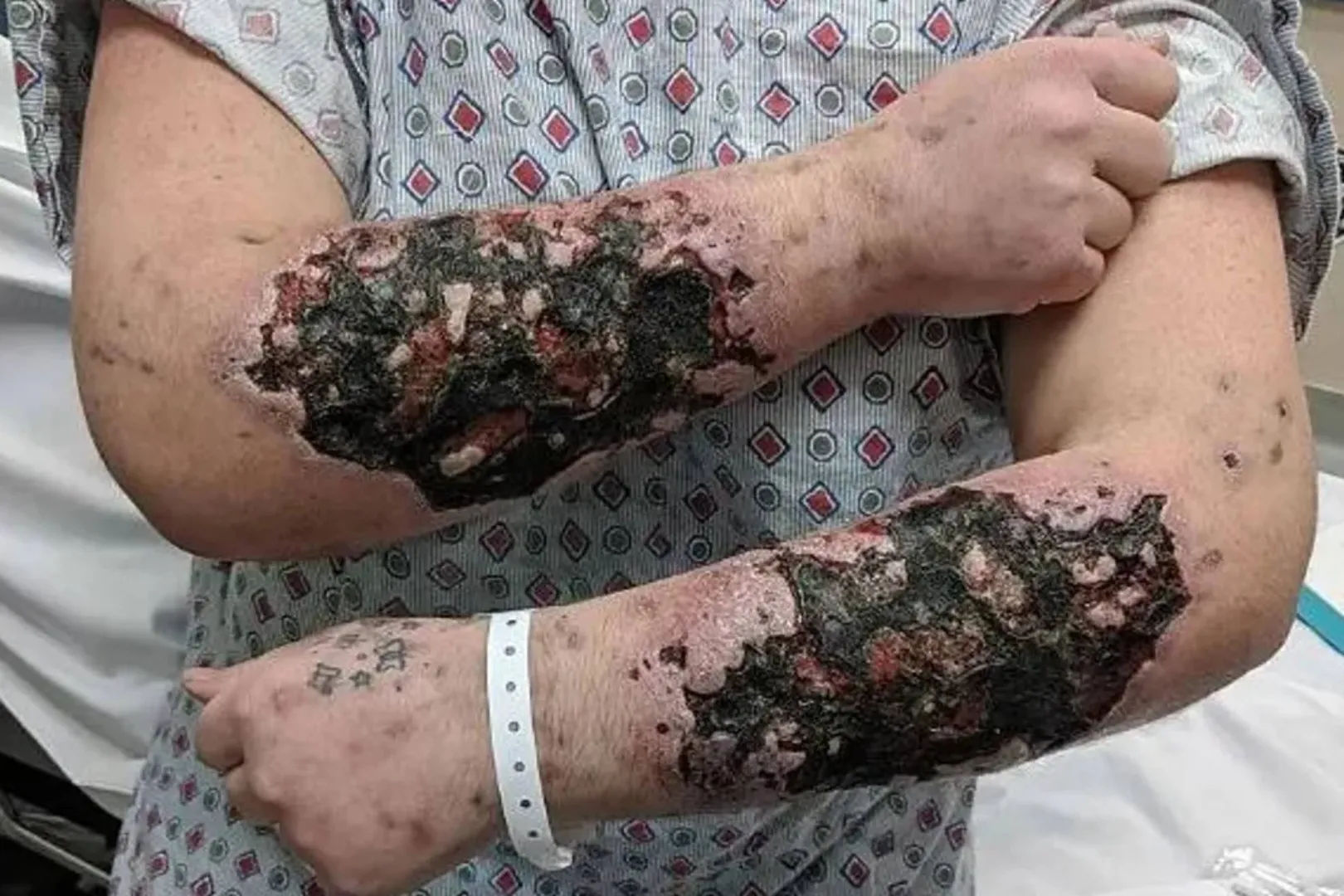 US County experiences 150 overdoses and 9 fatalities in 18 months due to flesh-rotting 'Zombie Drug'
