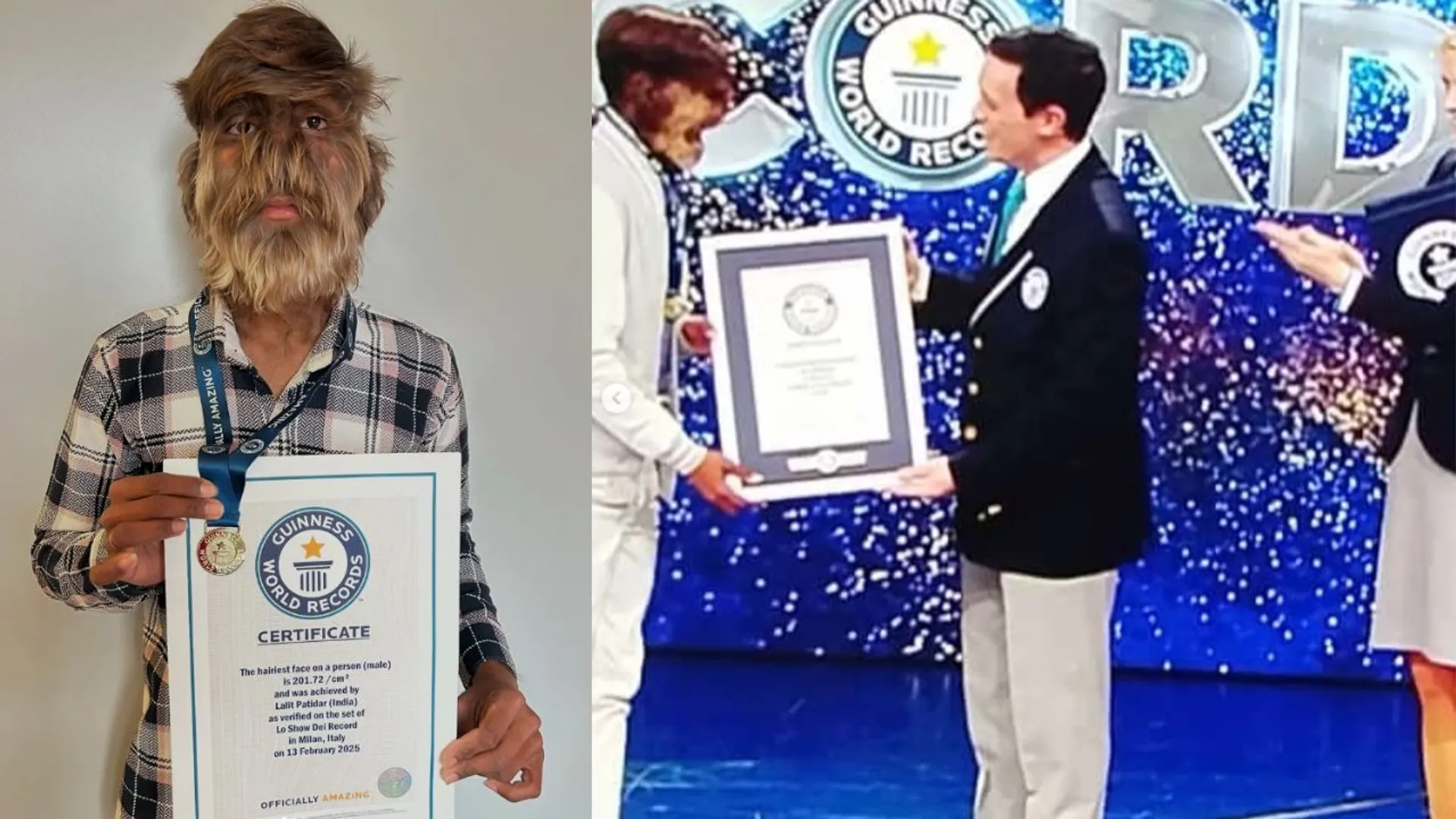 Werewolf Syndrome boy, secures the Guinness World Record for 'hairiest face'