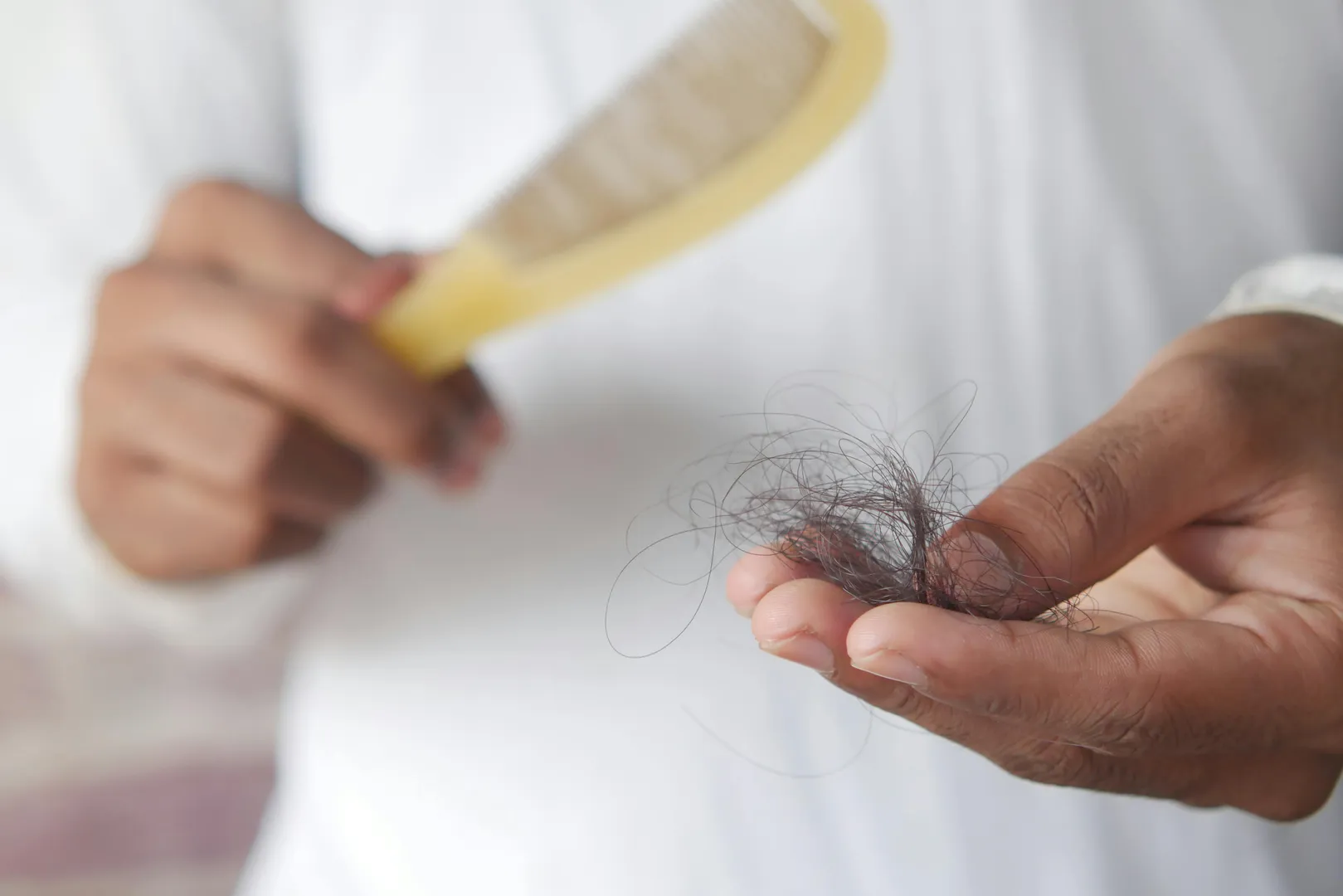 Hair loss in androgenetic alopecia