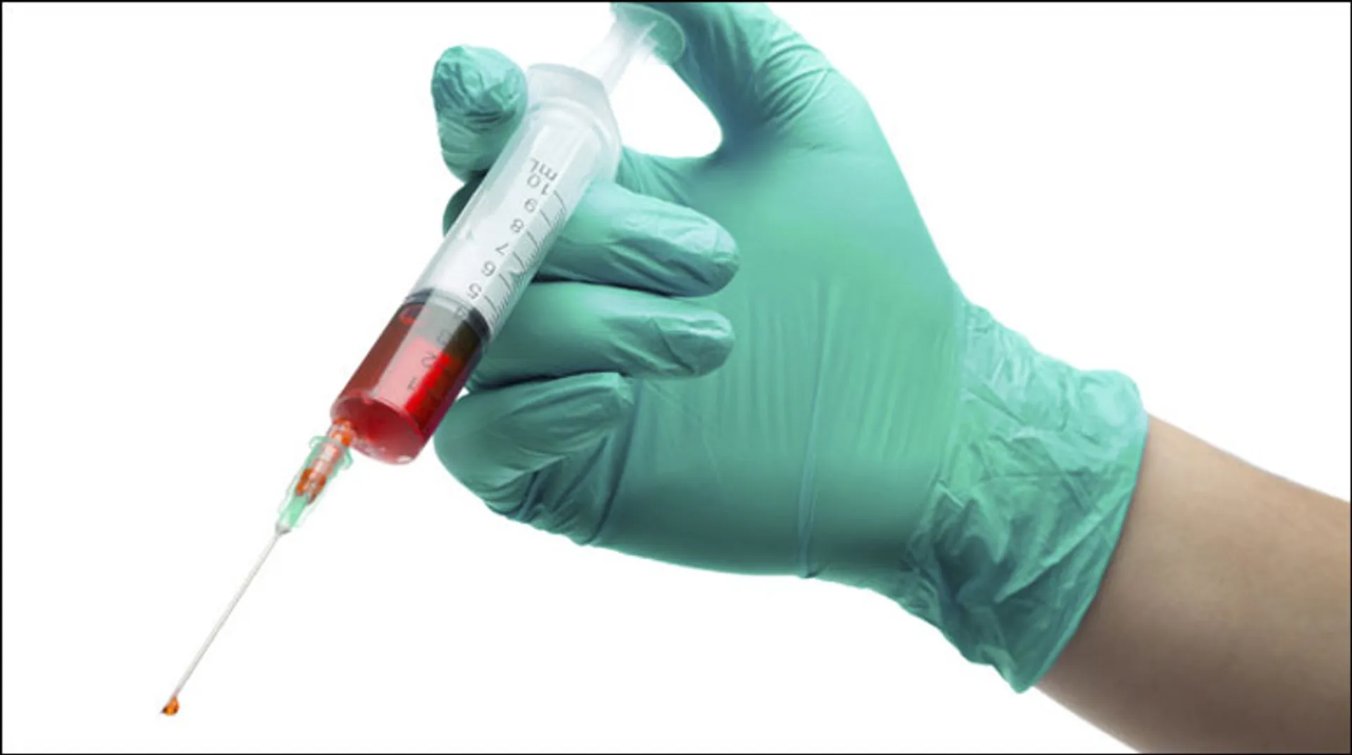 Second person declared cured of HIV, with no trace of infection in 30 months