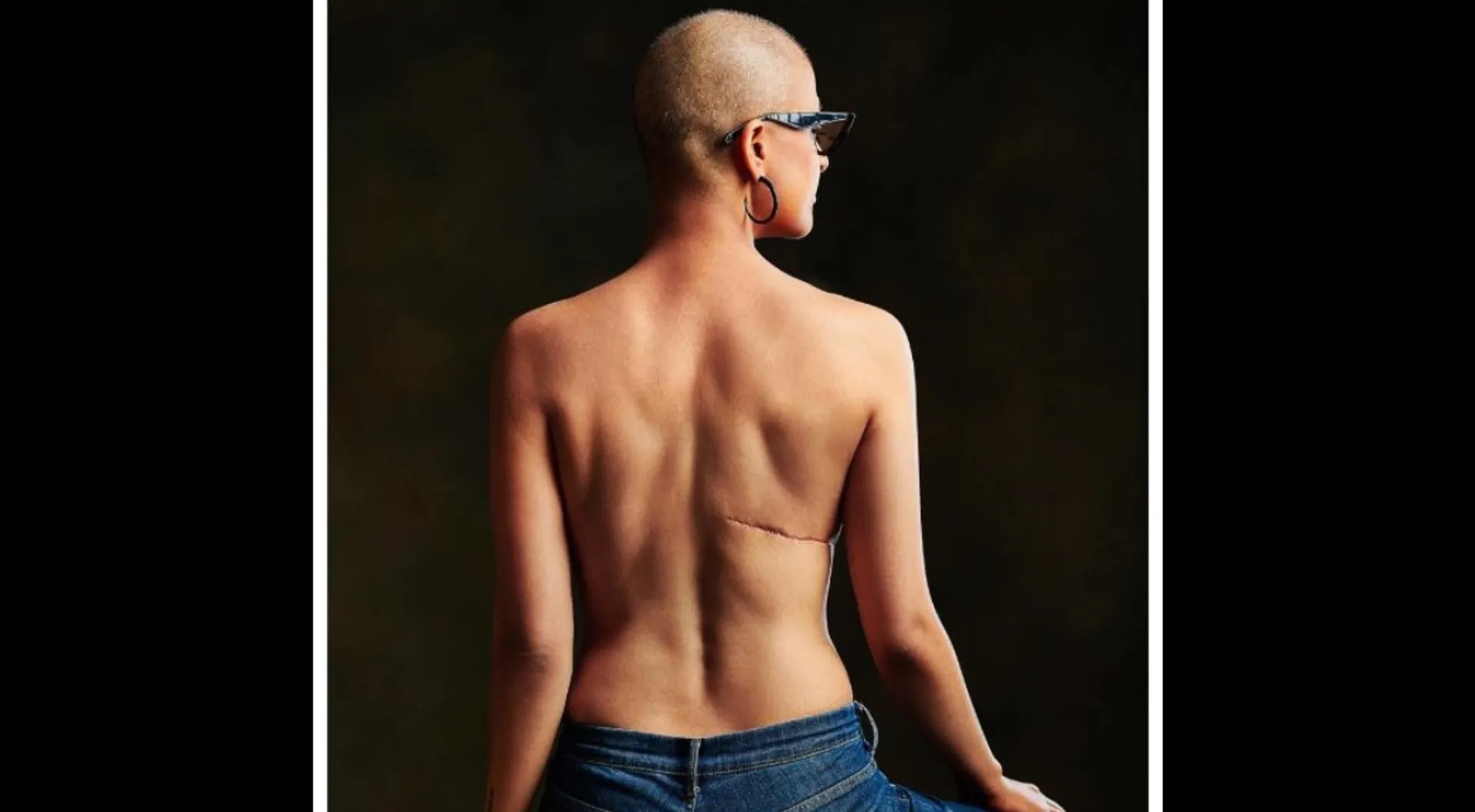 Tahira Kashyap poses topless as she flaunts her scars as badges of honour on World Cancer Day