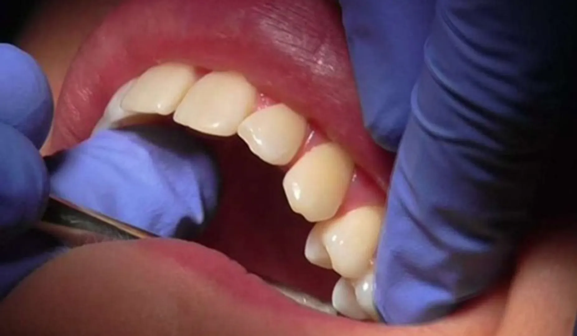 Don't ignore these new oral symptoms of Covid-19