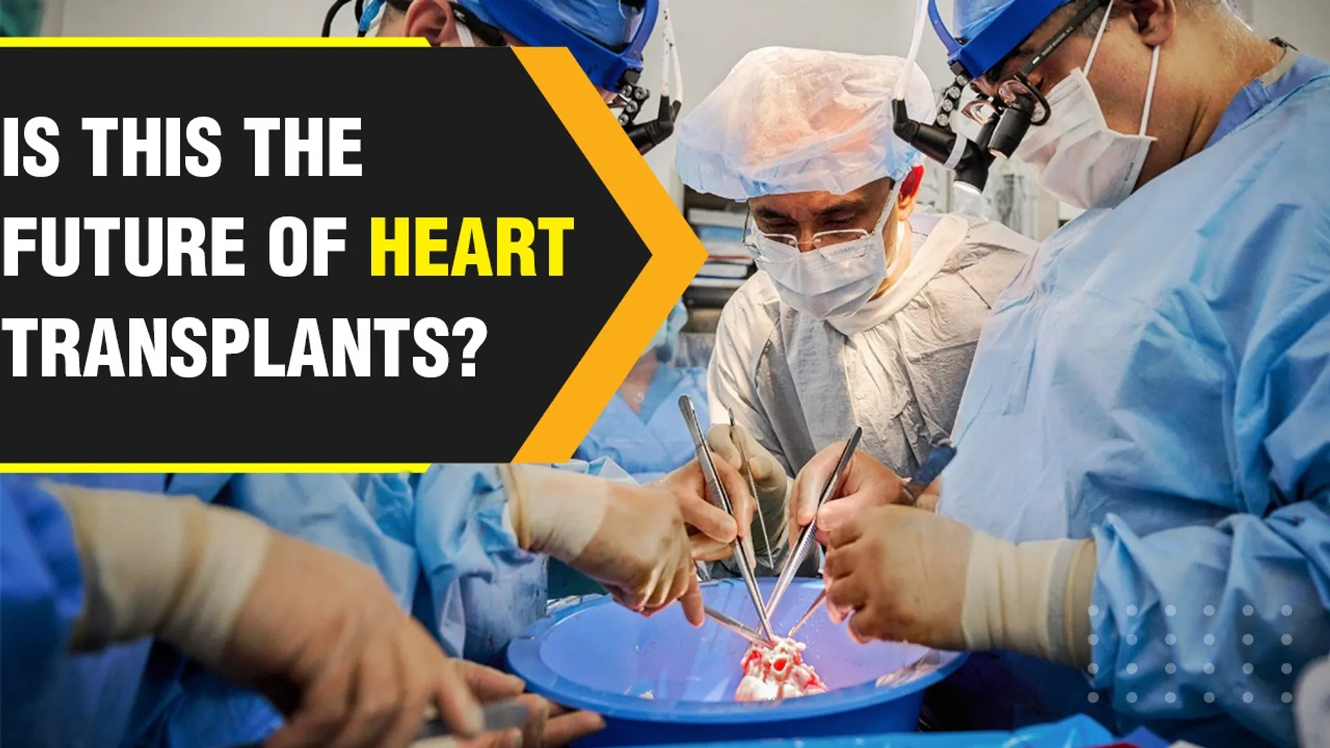 Surgeons transplant genetically engineered pig hearts into two brain-dead people