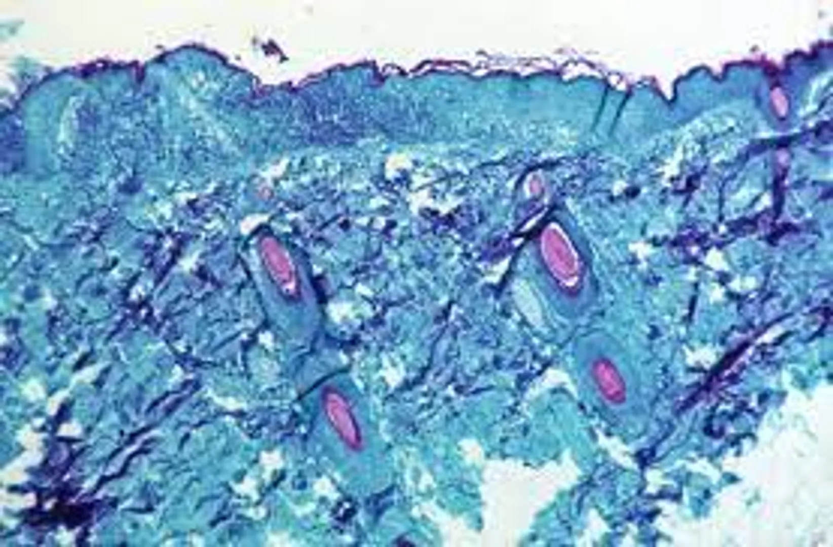 Monkeypox can spread even before developing symptoms in patient: Study
