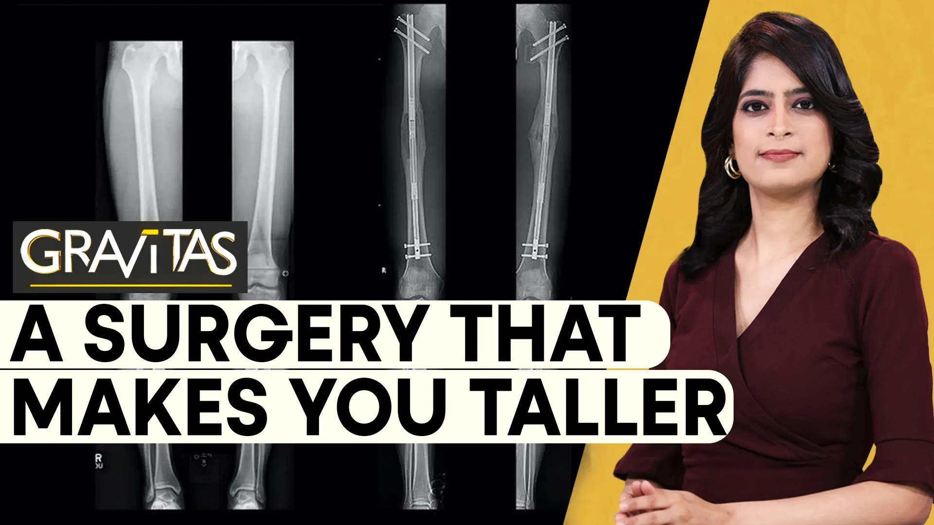 Gravitas: Would you go under the knife to increase your height?