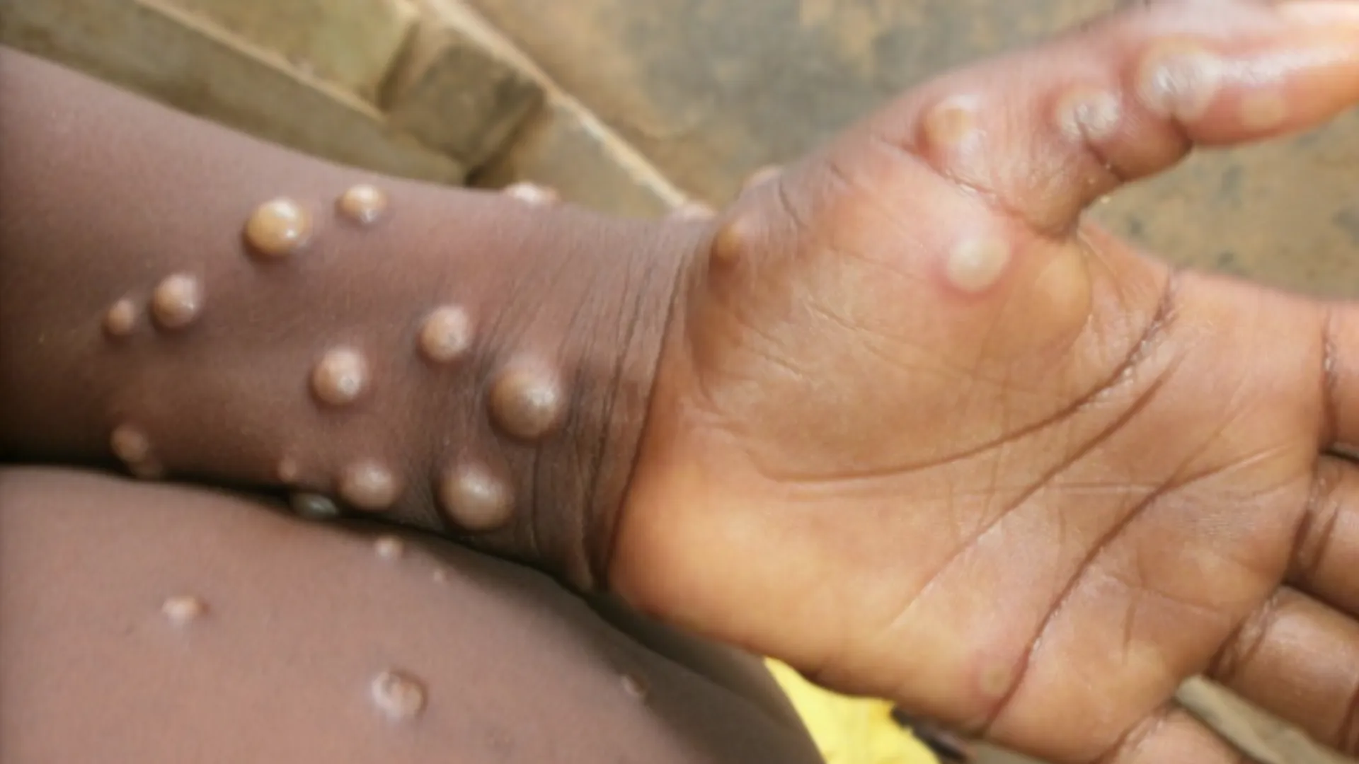 Mpox crisis: New cases reported in Pakistan, Peshawar a potential 'epicenter'
