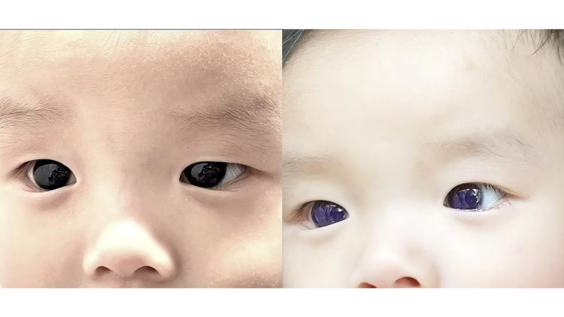 Infant's eye colour changes from dark brown to bright blue after COVID-19 treatment: Report