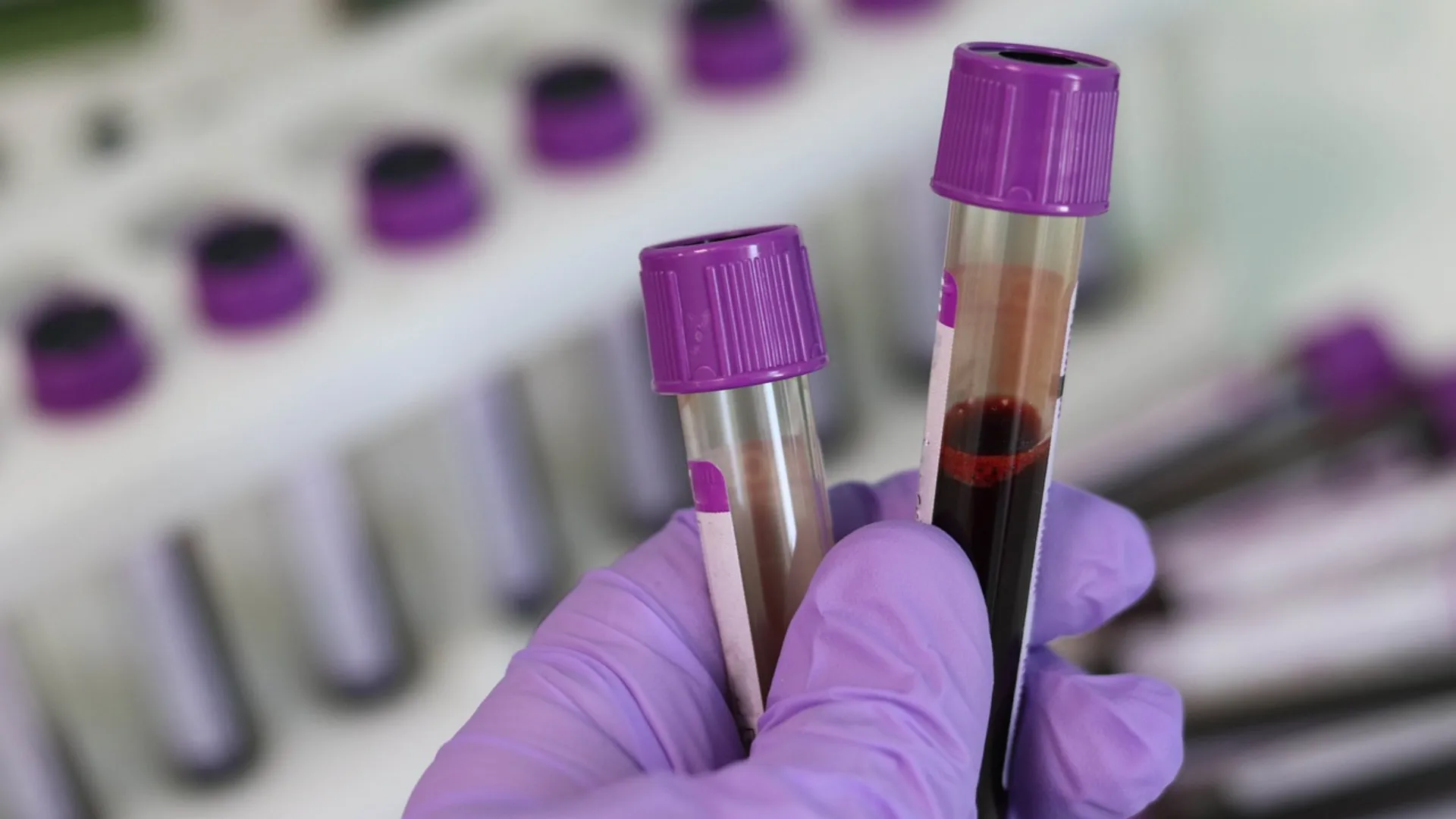A simple blood test will now be able to diagnose bipolar disorder. Here's how