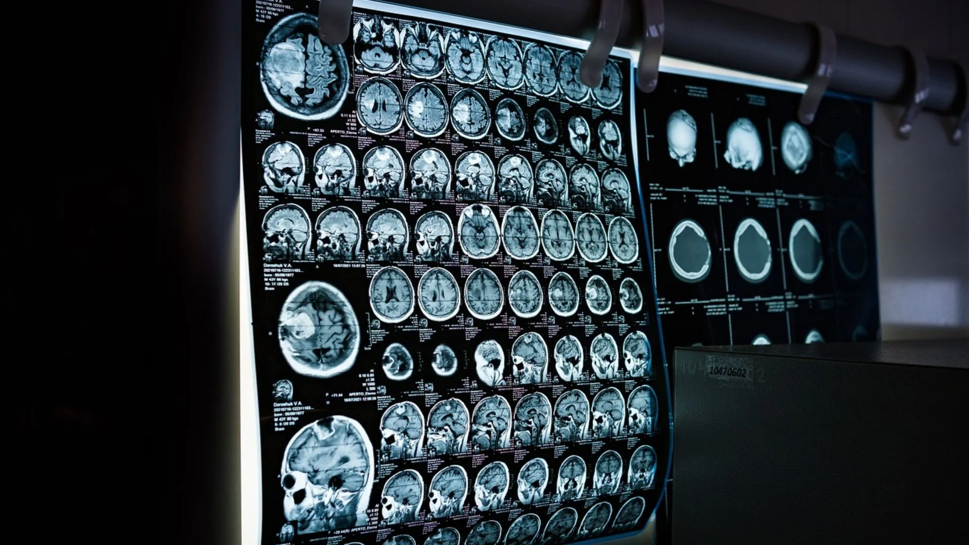 Scientists show ten-minute brain scan can predict dementia early