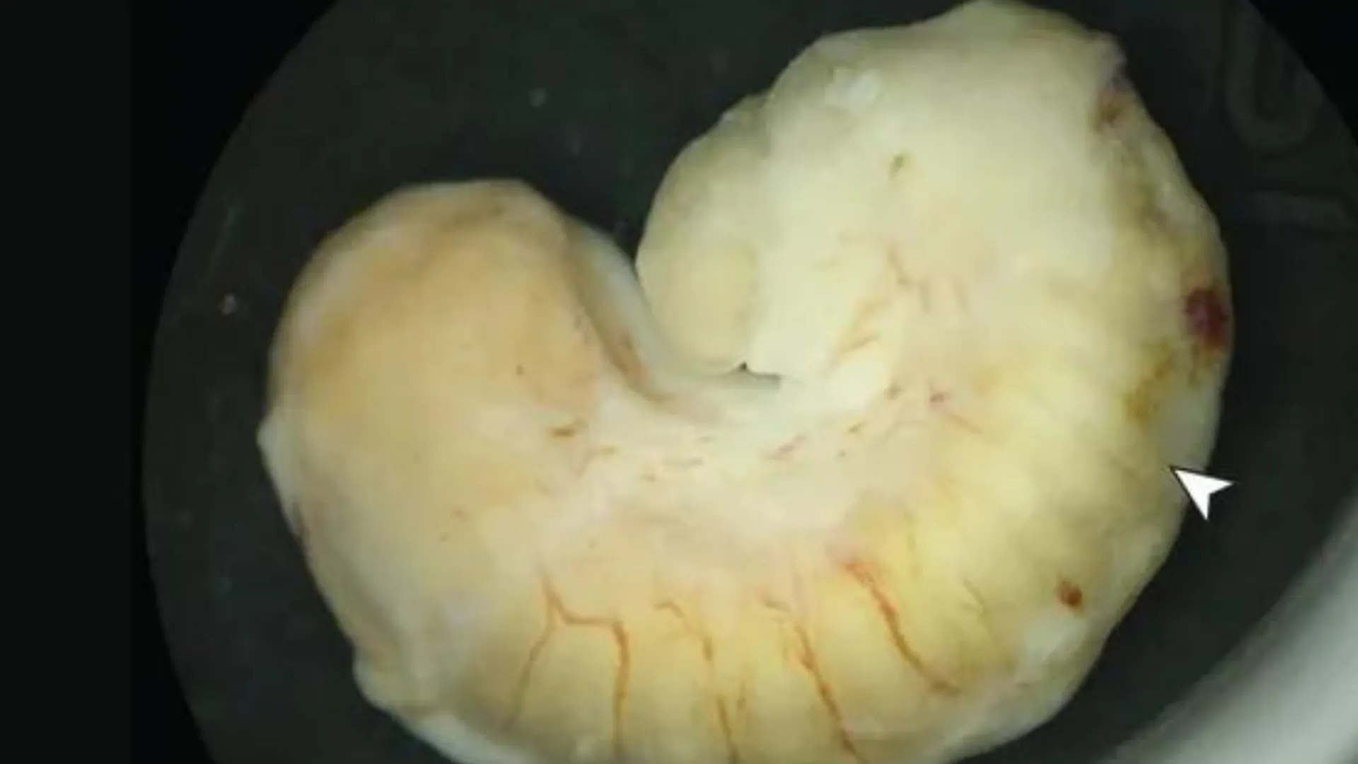 A parasite lived and grew in a woman's eye for two years. Doctors believe contaminated...