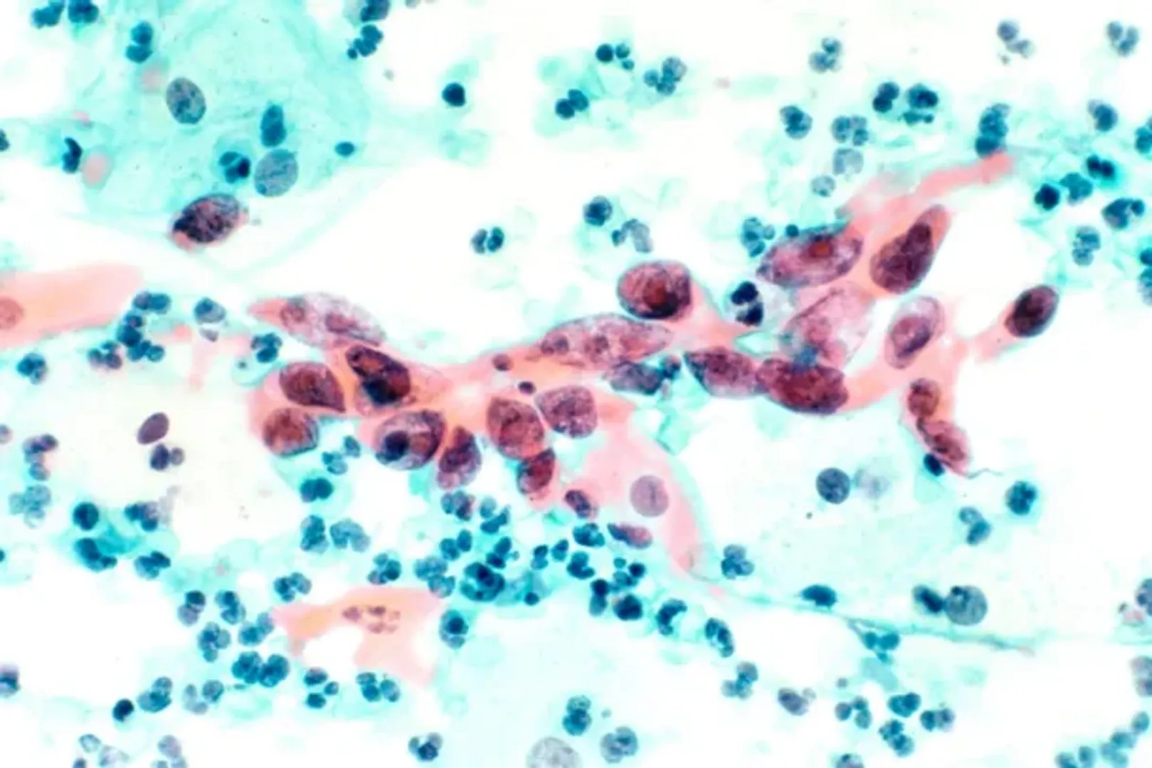 Cervical cancer treatment breakthrough that can cut risk of death by 40 per cent found