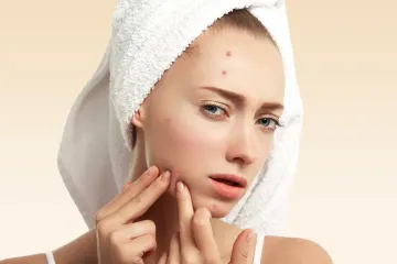 How to Get Rid of Pimples