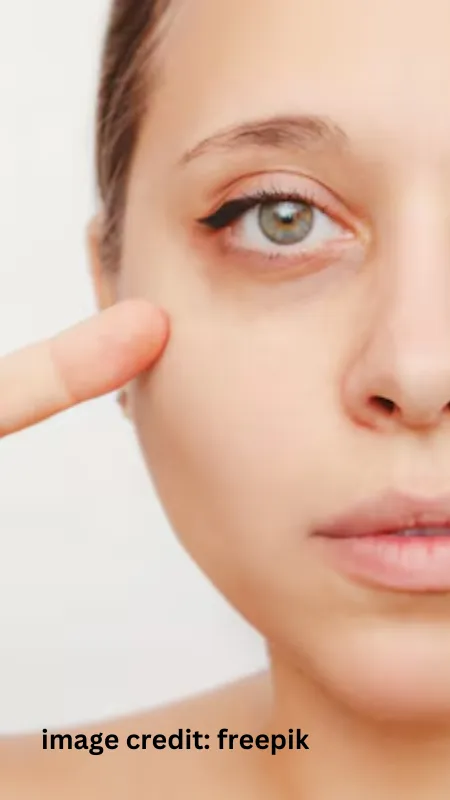 dark circles