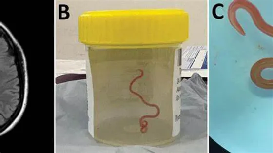 Australia: Woman Discovers Live Worm in her Brain, a World First