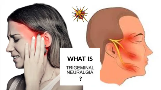 Discover What is 'Suicide Disease' – Understanding Trigeminal Neuralgia in Detail and Urging Awareness!