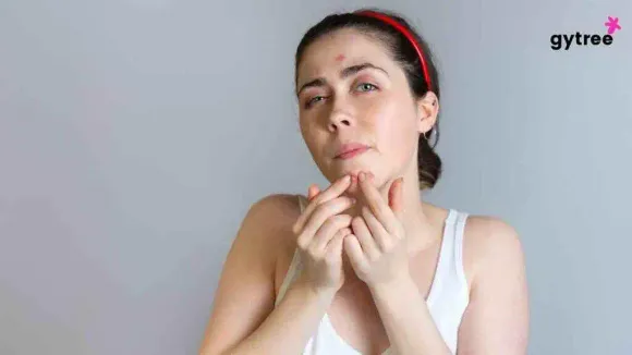 Say Goodbye to Acne on Chin and Forehead: 10 Tips for Clear and Glowing Skin