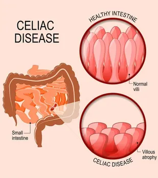 SIGNS AND SYMPTOMS OF CELIAC DISEASE