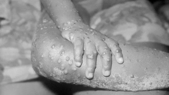 CANADA INVESTIGATING CASES OF MONKEYPOX IN THE COUNTRY As OUTBREAK SPREADS IN U.S And EUROPE