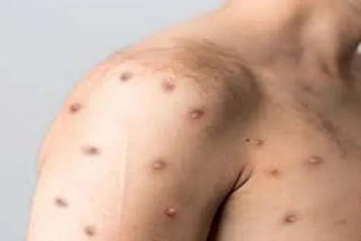 First monkey pox case in New Zealand