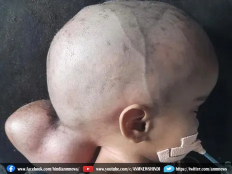 10 महीने की बच्ची के सिर की surgery कर निकाली गई गांठ