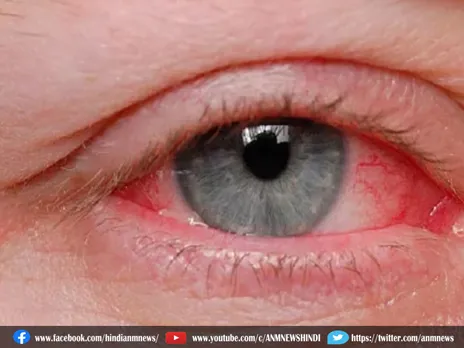 Eye Flu के साथ इस बीमारी का खतरा बढ़ रहा है तेजी से
