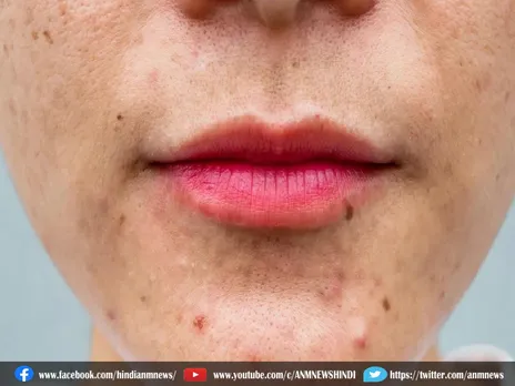 Beauty Tips: बेदाग चेहरा और मुहांसों से छुटकारा पाने के लिए दूरी बनाए इन फूड आइटम से