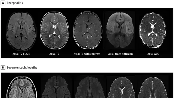 Omicron Variant Triggers High Incidence of Cerebrovascular Lesions in Children, Study Finds
