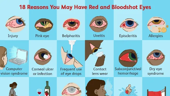 Unveiling the Causes: Experts Shed Light on Rising Cases of Bloodshot Eyes