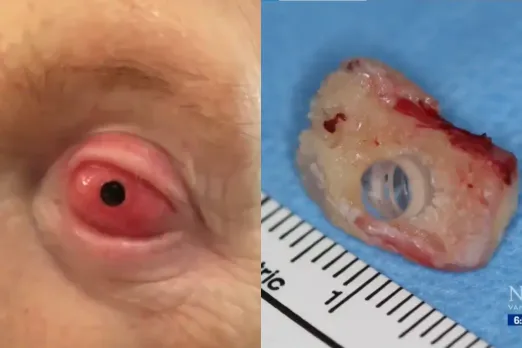 Tooth in eye surgery