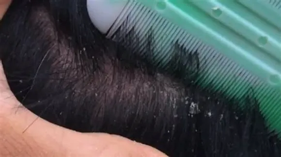 Tips to get rid of dandruff
