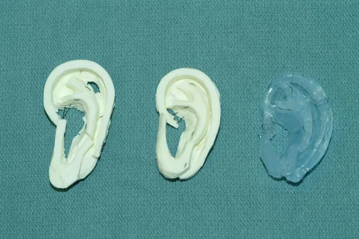 How 3D printing techniques are helping surgeons carve new ears