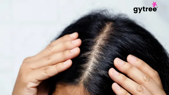 What is male and female pattern baldness?