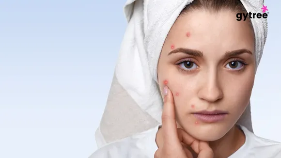 Is your acne indicating any underlying health issue?