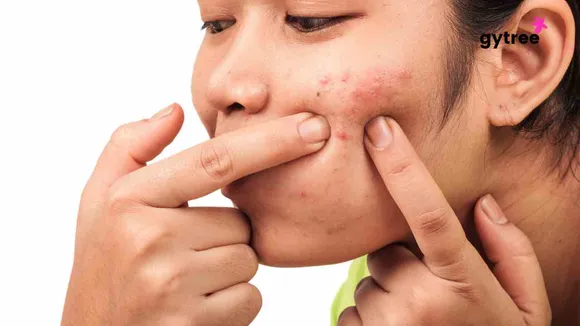 Stress and acne: Are they related?