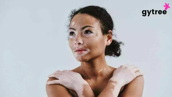 Vitiligo: Symptoms, Causes & Treatment