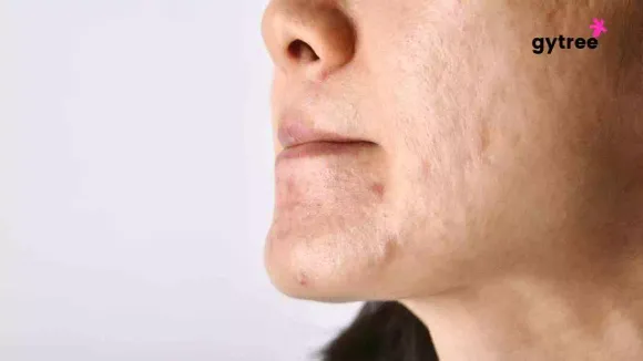 How to clear acne and pigmentation permanently?