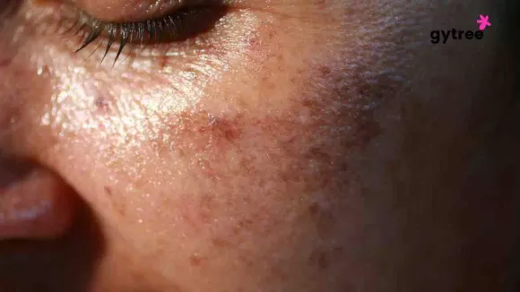 Acne and Pigmentation: 9 Effective ways to manage.