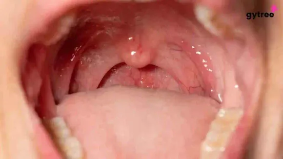 Unveiling the Realities of Oral STDs: Understanding Transmission, Types and Prevention