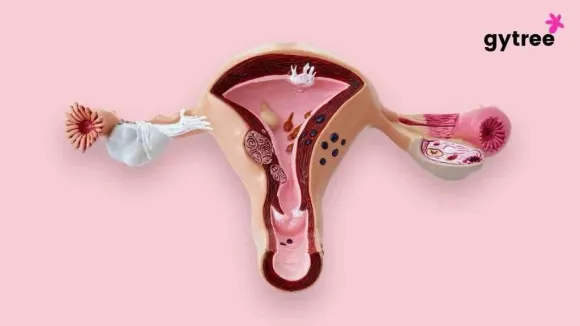 Polycystic Ovary Syndrome - Common Symptoms, Causes and Treatment