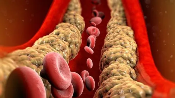 Cholesterol: कोलेस्ट्रॉल को करेंगे इग्नोर तो हो सकती हैं ये दिक्कतें