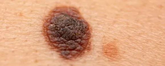 Melanoma: तिल नहीं स्किन कैंसर मेलेनोमा तो नहीं है कहीं आपको