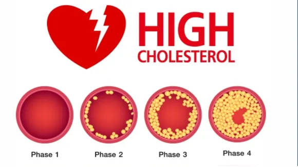 Control Cholesterol: जाड़ों में कैसे नियंत्रित करें बढ़ता कोलेस्ट्रॉल