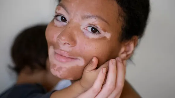 vitiligo 