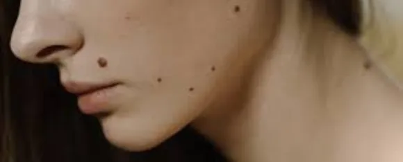 Mole Marks: चेहरे से तिल के निशान कैसे कम करें