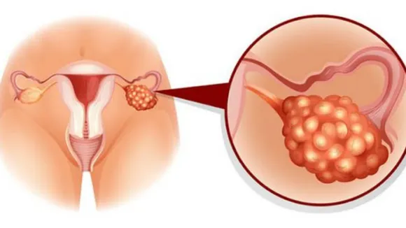 Myths About PCOD: ये हैं PCOD मिथ्स, इन्हें सच मानने की गलती न करें