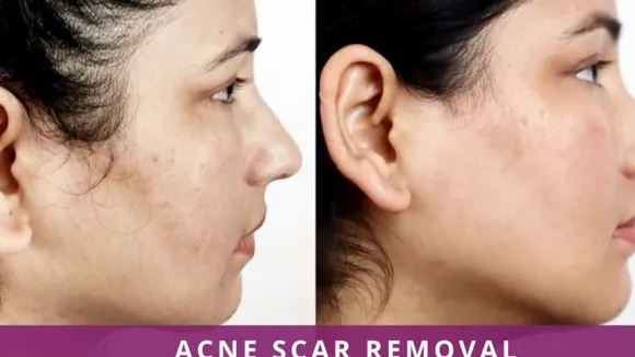 Acne : एक्ने को काम करने के तरकीब