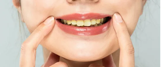 Yellow Teeth: पीले दांतों से छुटकारा पाने के जानें 5 घरेलू नुस्खे
