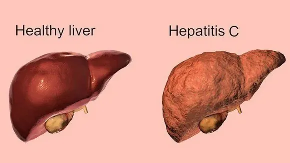 Hepatitis C वे
